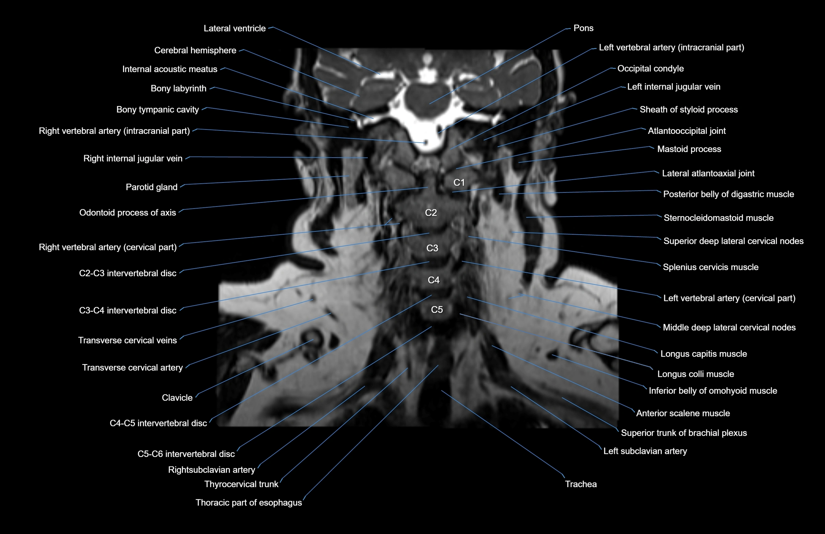 Neck coronal cross sectional MRI anatomy 3T MRI  image-img-00001-00031.webp